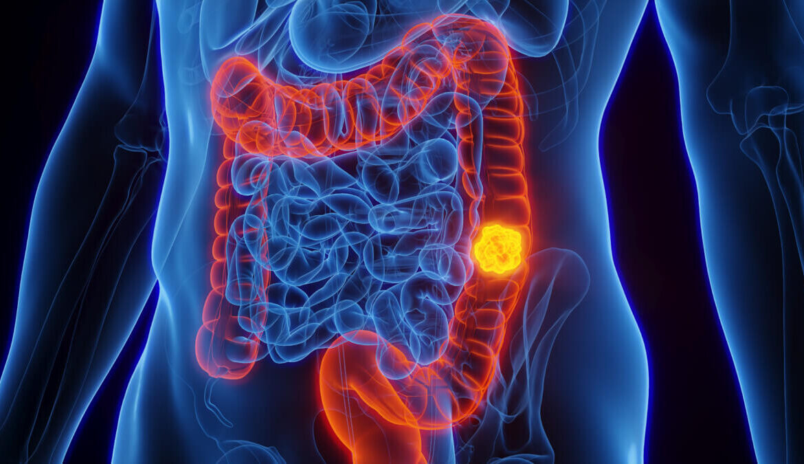 Understanding Colorectal Cancer: Symptoms, Treatment, and Prevention