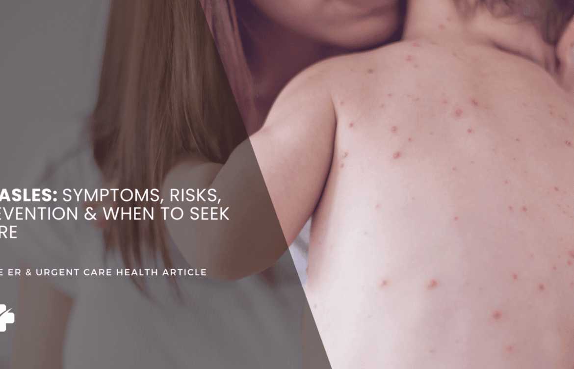 Recognizing Measles Symptoms for Early Intervention