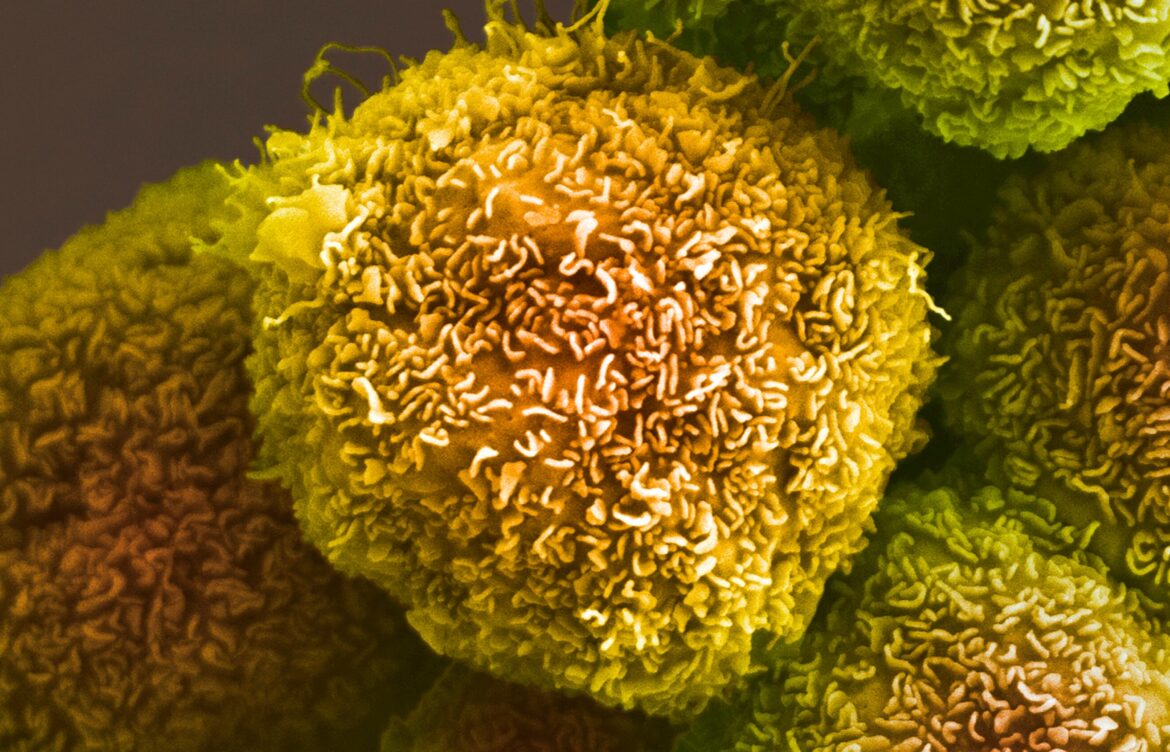 Recent Advances in Pancreatic Cancer Cure Research