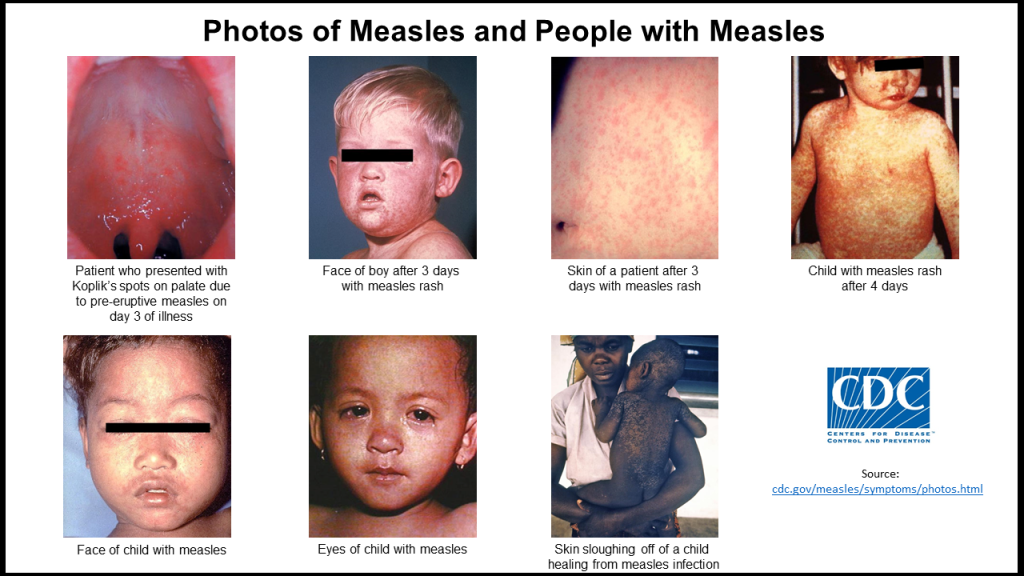 Measles Outbreaks: Understanding the Recent Surge