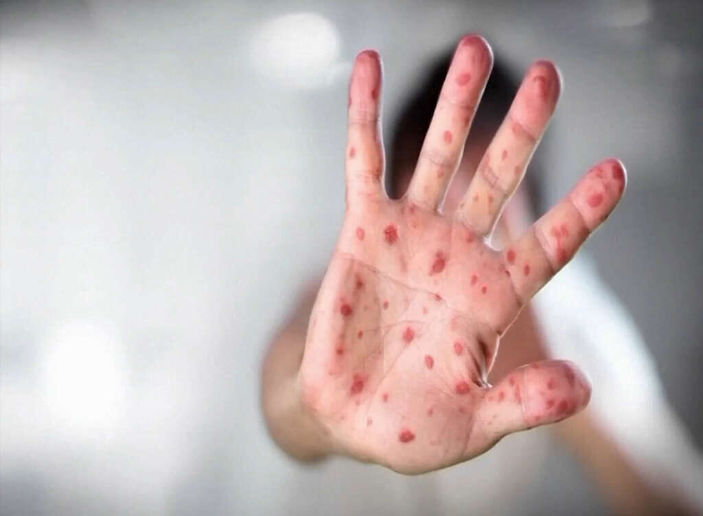 What You Need to Know About Measles Symptoms