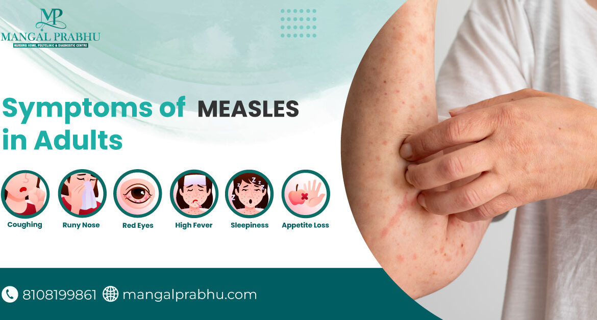 Understanding Measles Symptoms and Their Importance