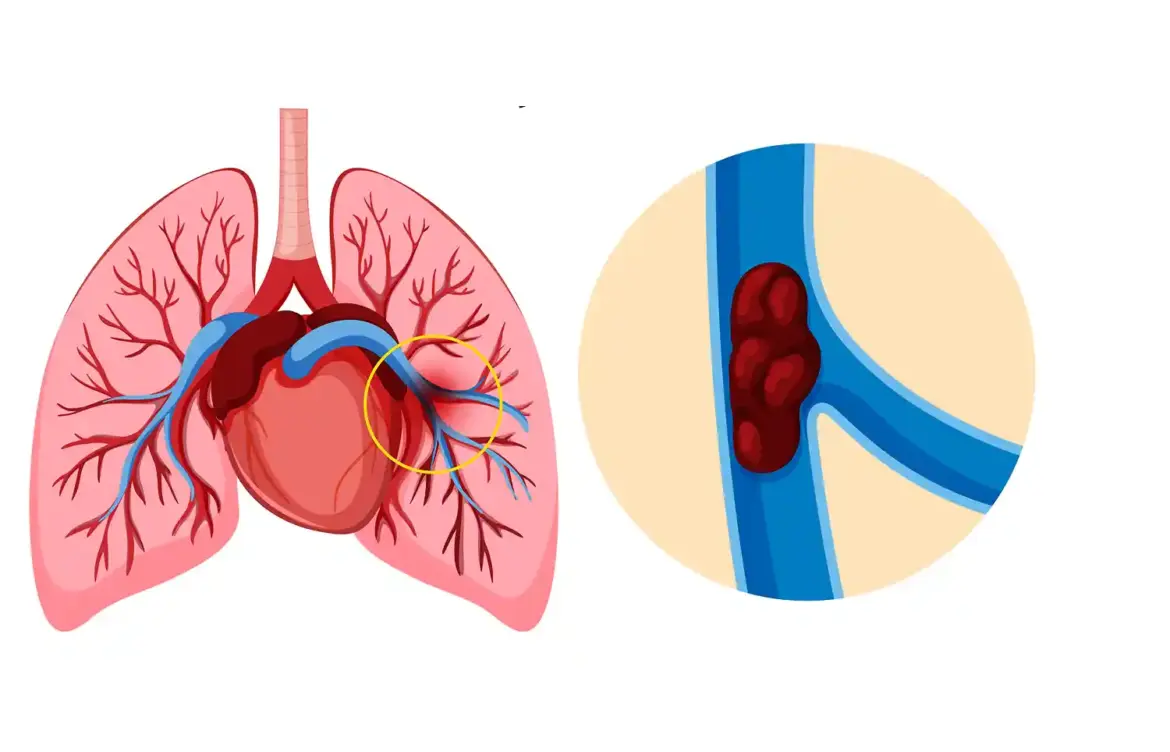 Understanding Pulmonary Embolism: Risks and Treatments